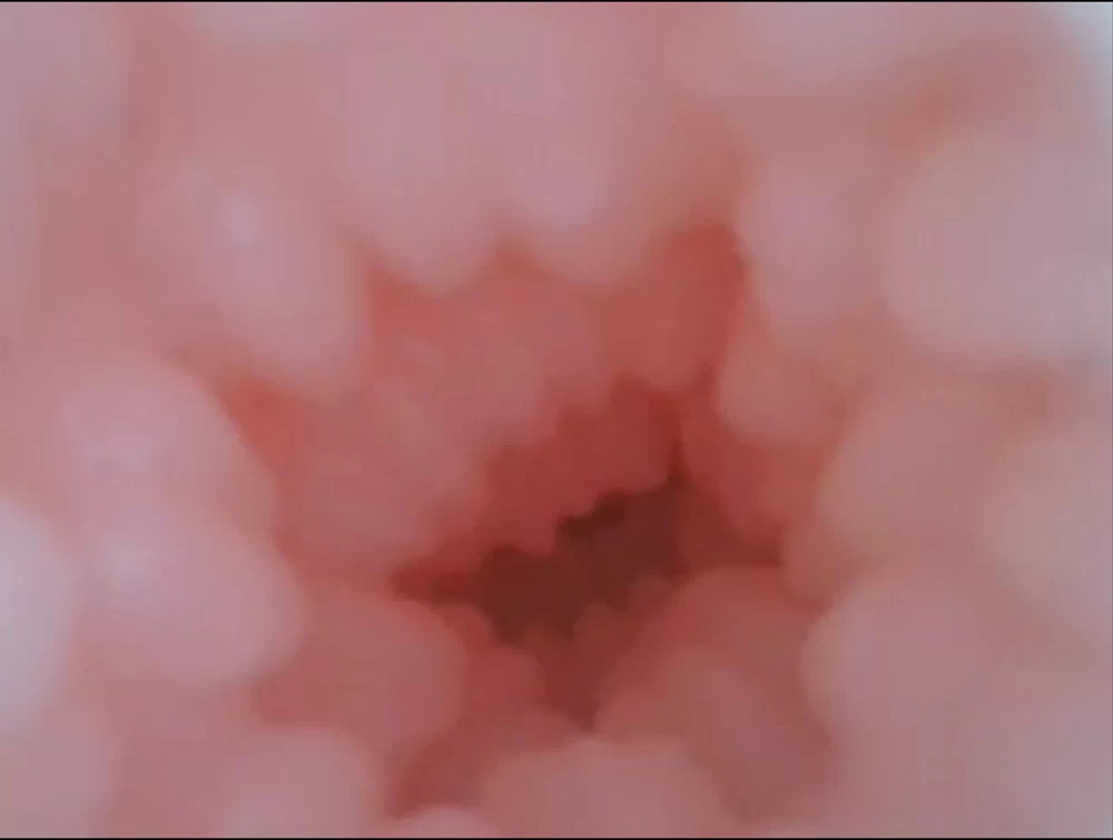 Lõi âm đạo bên trong 