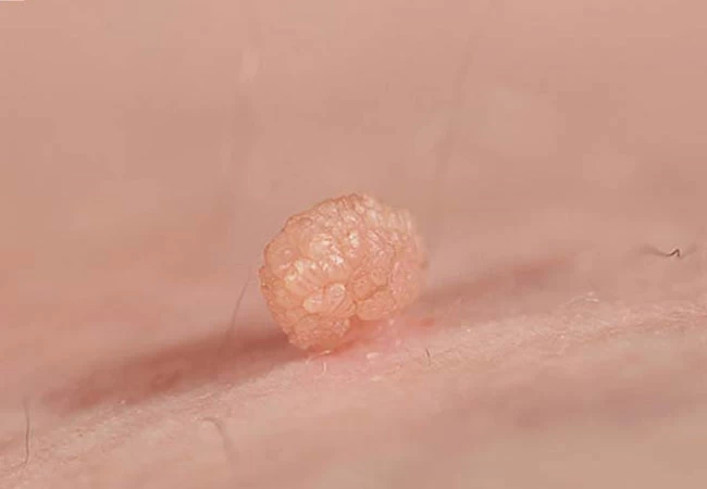 Bệnh herpes sinh dục