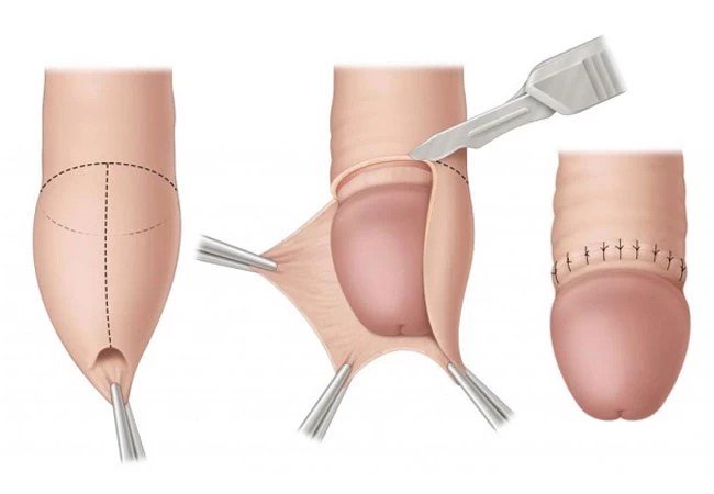 Những cách phòng tránh bệnh lây qua đường tình dục không nên bỏ qua