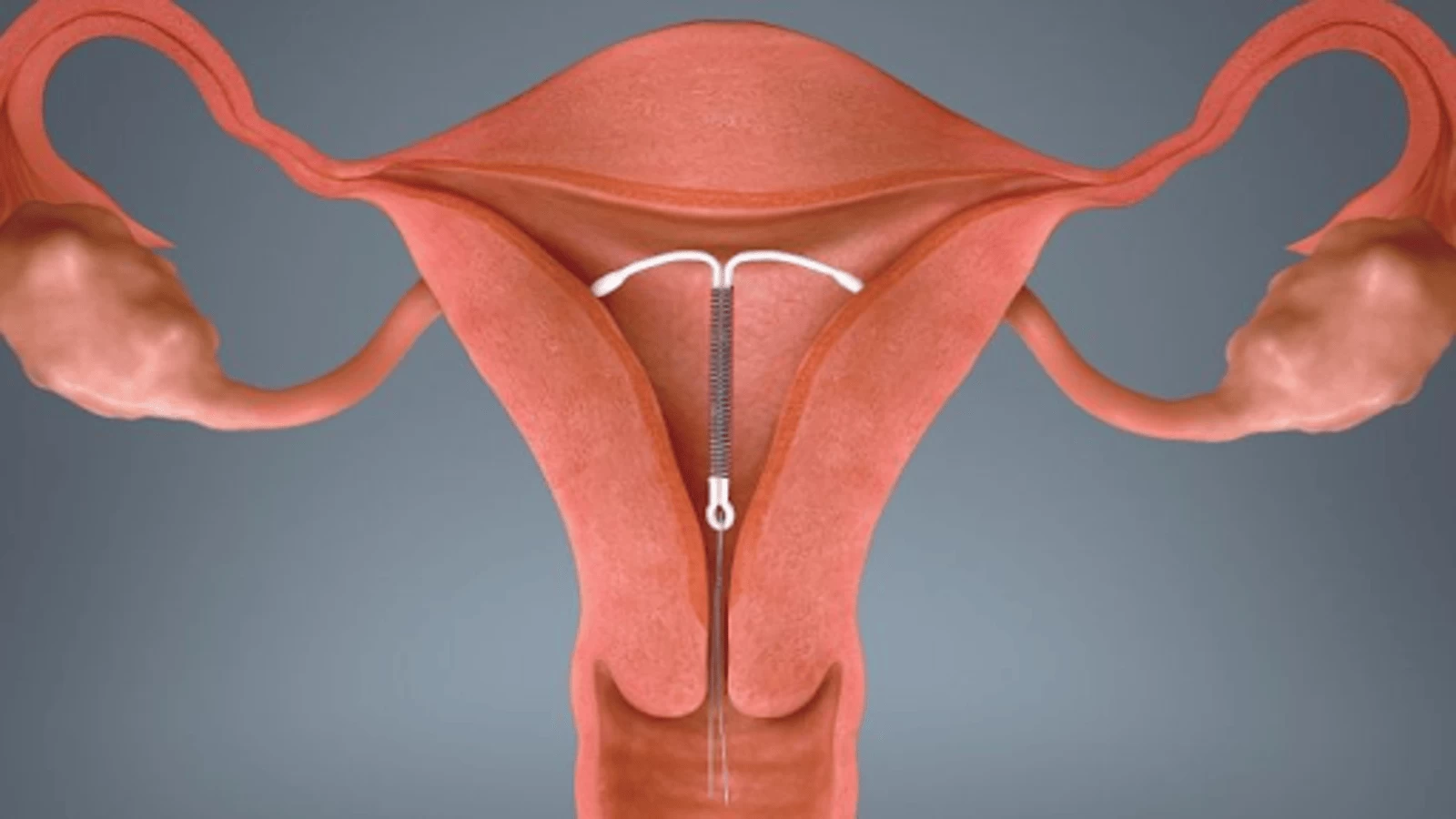 Vòng tránh thai là gì?