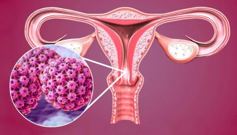 HPV là “kẻ sát nhân thầm lặng” gây ung thư cổ tử cung ở nữ giới