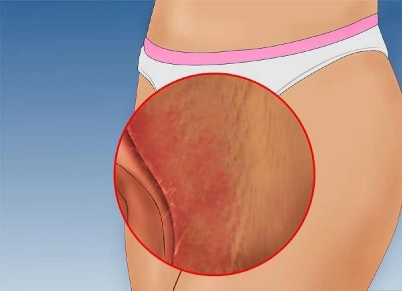 Vùng da vùng kín bị viêm đỏ, mẩn ngứa