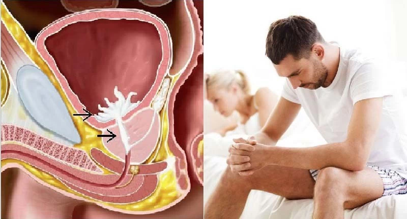 Tinh dịch đi ngược vào bàng quang khiến nam giới lên đỉnh khô