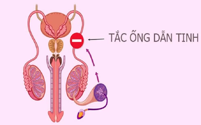 Ống dẫn tinh bị tắc nghẽn