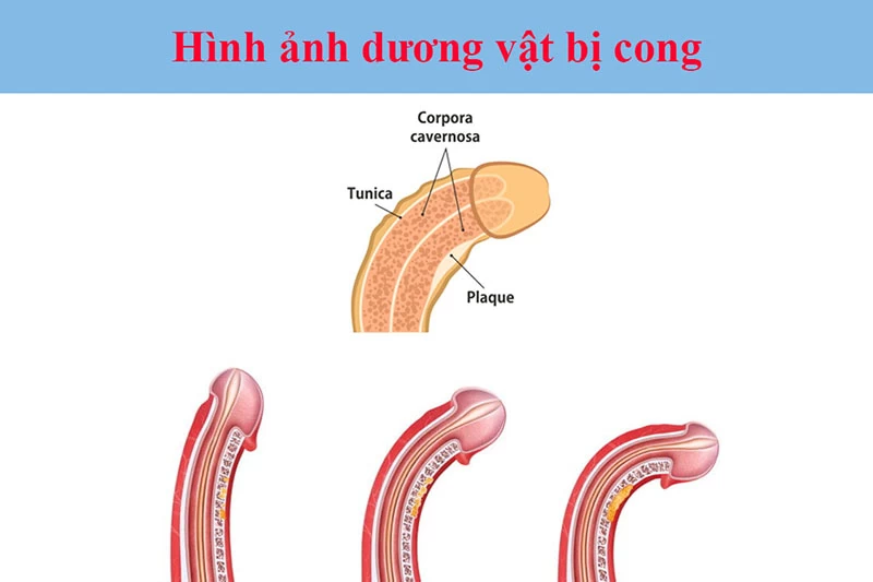 Tình trạng dương vật cong ở nam giới