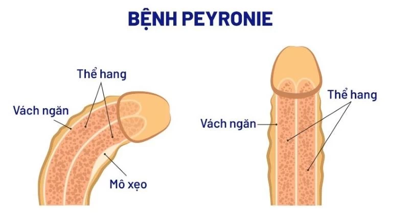 Bệnh Peyronie là nguyên nhân phổ biến khiến dương vật cong và đau ở nam giới