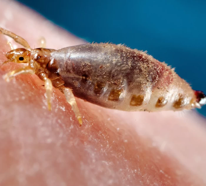 Hình ảnh cận cảnh rận mu (Pthirus pubis) giống con cua bám trên lông