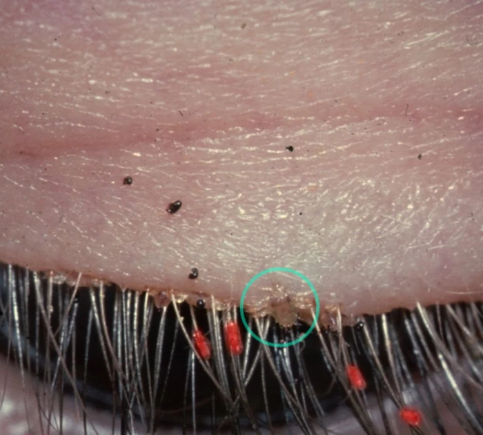 Các vùng cơ thể rận mu thường ký sinh: lông mu, lông nách, lông mi