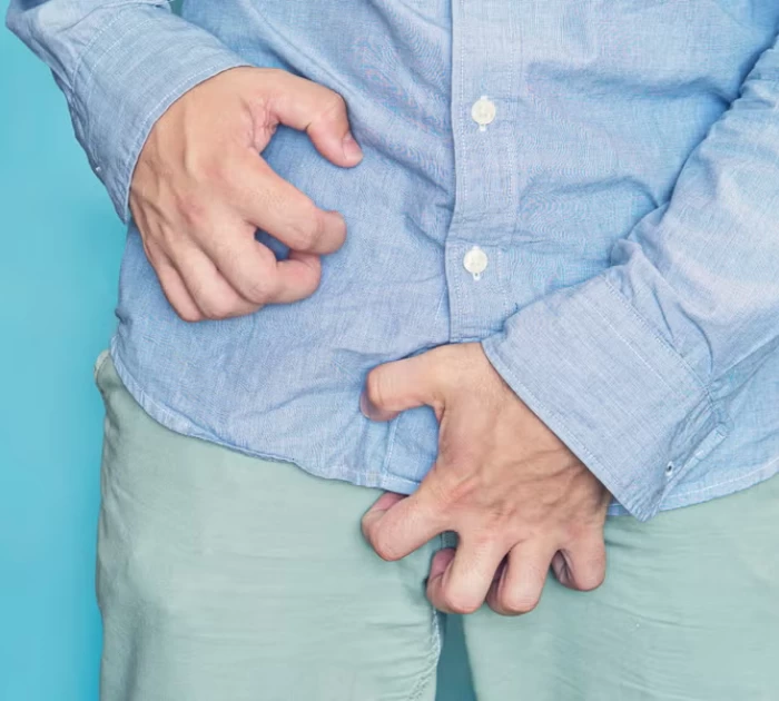 Vết cắn và phát ban trên da do nhiễm rận mu gây ngứa dữ dội