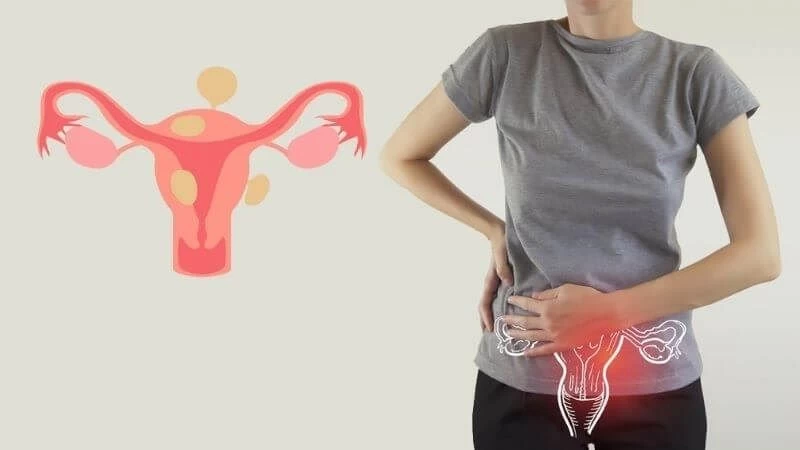 Buồn nôn sau quan hệ tình dục vì lạc nội mạc tử cung