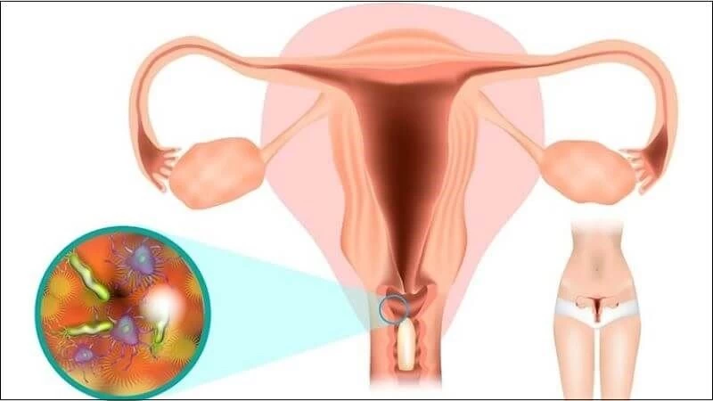 Đau bụng kinh nhiều hơn khi quan hệ trong chu kỳ