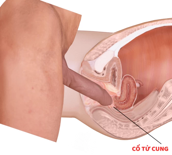 Thế nào là cực khoái cổ tử cung?