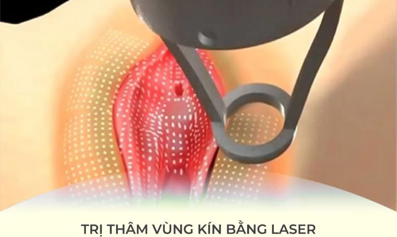 Công nghệ thẩm mỹ hỗ trợ làm sáng vùng kín nhanh